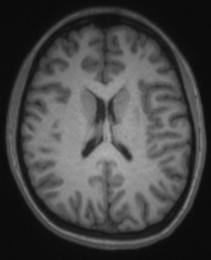 t1 axial brain